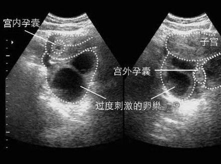 三代试管孕五周可以自己用试纸测宫外孕吗？